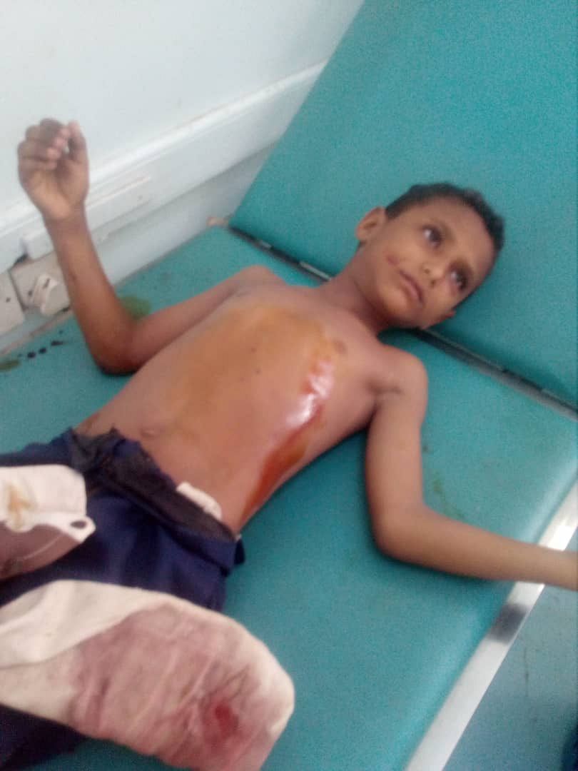 (ميون) لحقوق الإنسان تدين هجومًا حوثيًا أصاب عدة اطفال جنوب الحديدة